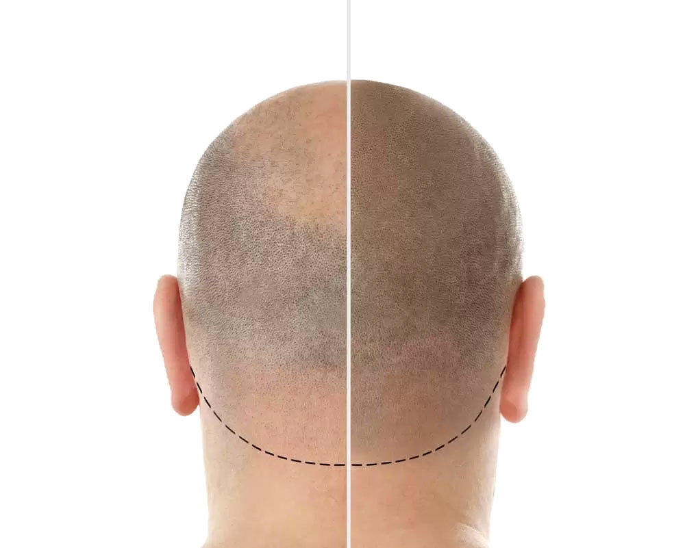 Tricopigmentazione, prima-dopo. Esempio di risultato (nuca).