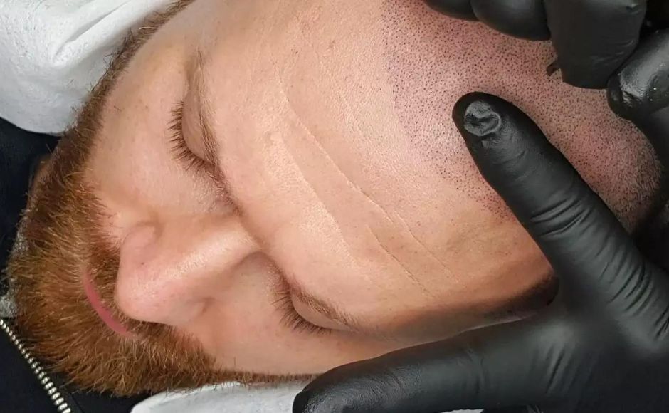 Costi tricopigmentazione